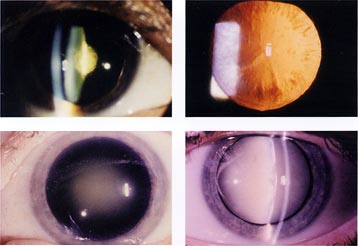 examples of cataract types